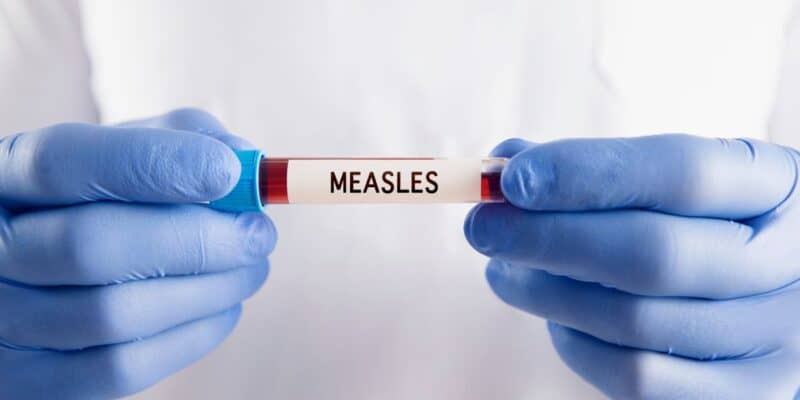 Gloved hands hold a test tube labeled “Measles” with a blood sample, emphasizing the health concerns during the recent measles outbreak that forced guests to cancel their Universal Studios Hollywood vacations.